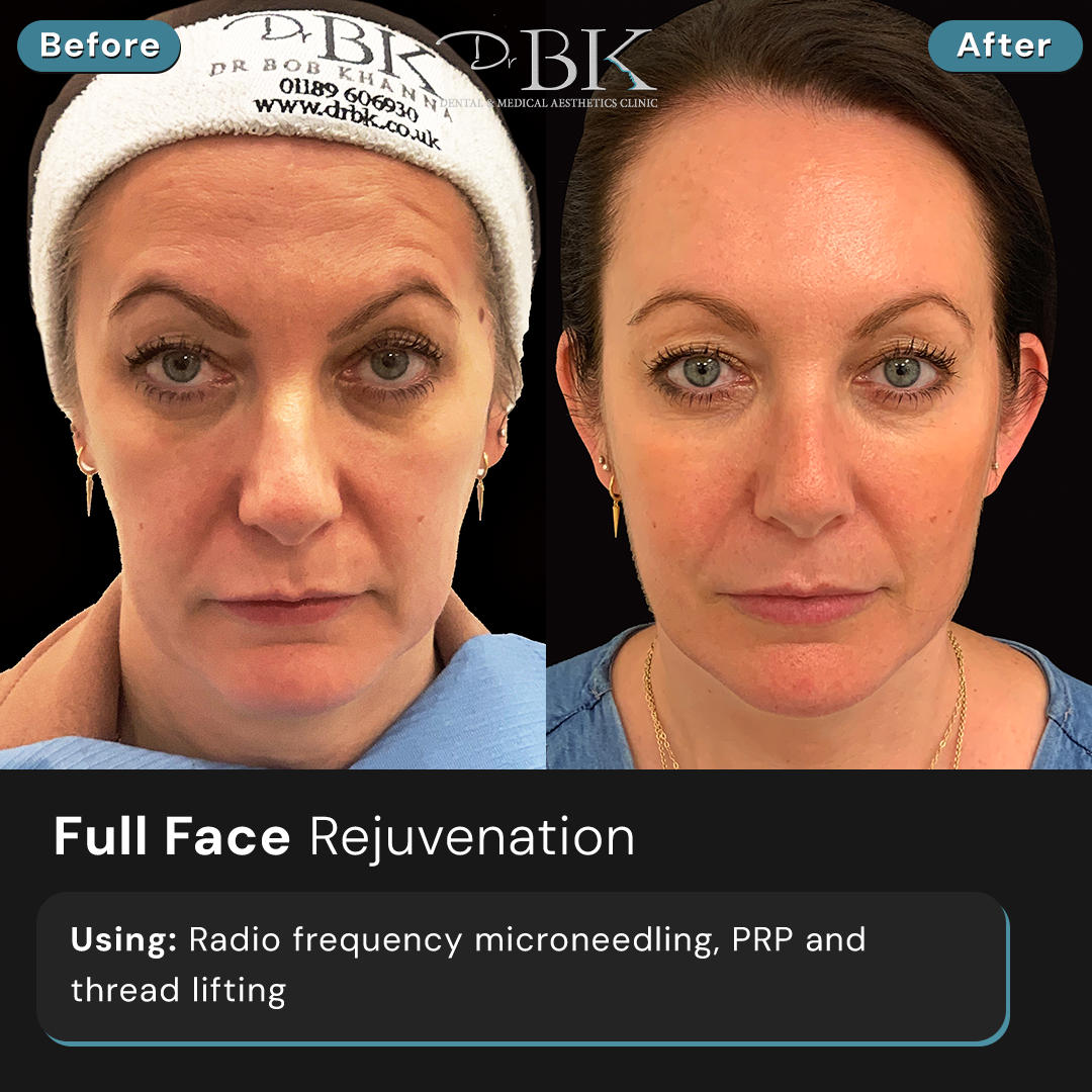 Radio Frequency Microneedling, PRP & Threads at DrBK