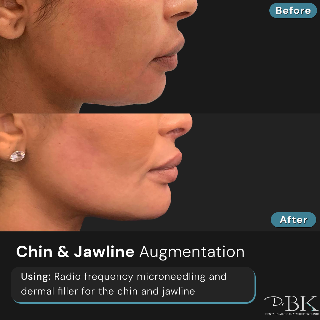 Radio Frequency Microneedling & Dermal Filler at DrBK