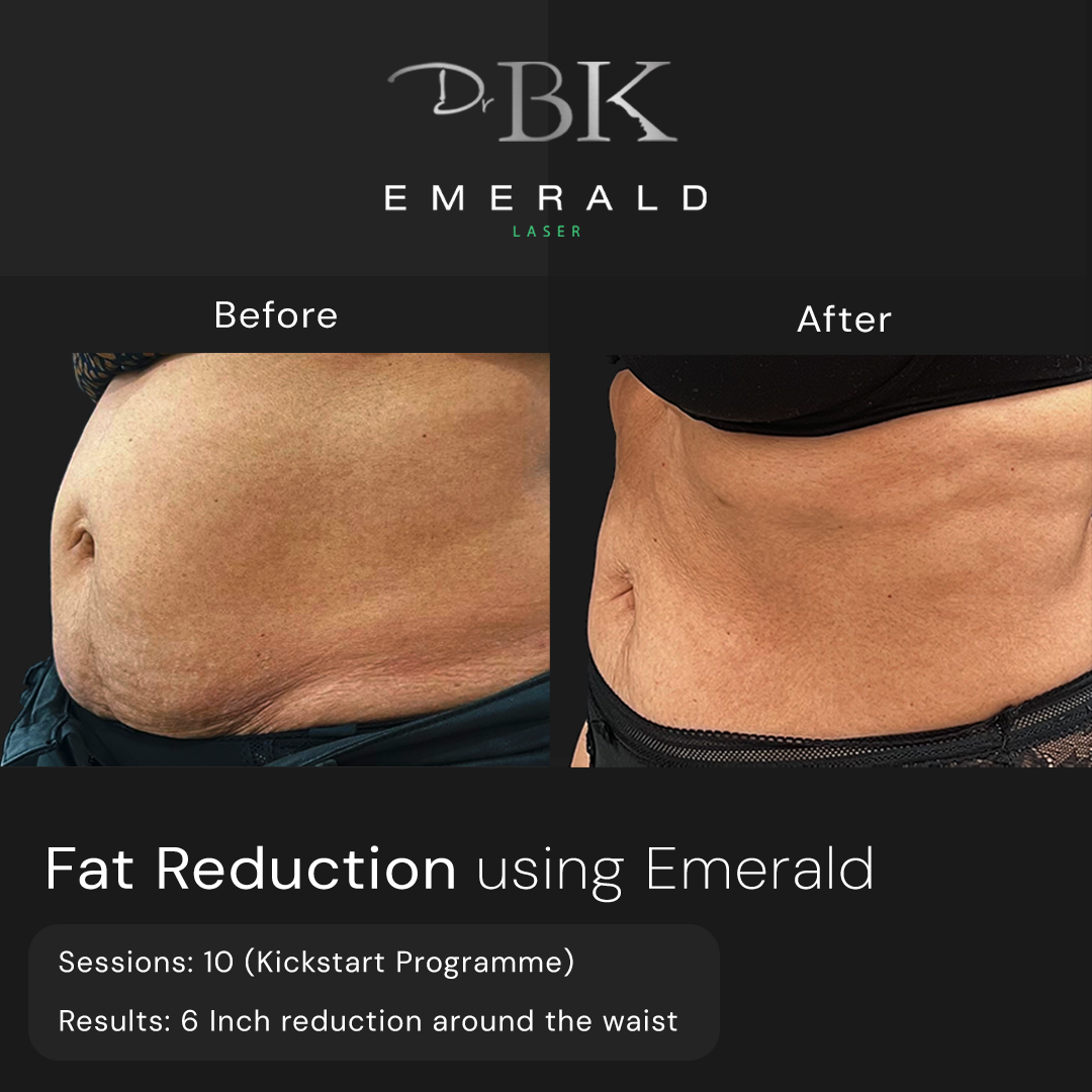 Emerald Fat Loss Laser at DrBK - Before & Afters