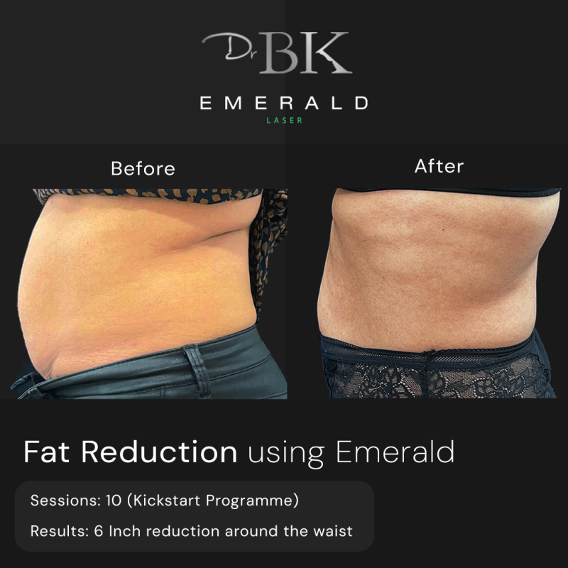 Emerald Fat Loss Laser at DrBK - Before & Afters