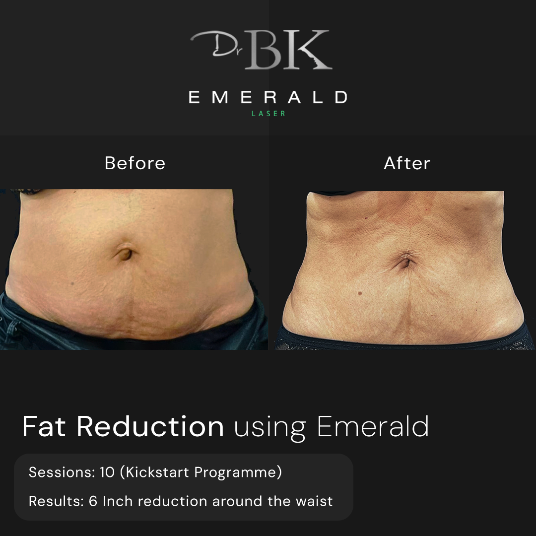 Emerald Fat Loss Laser at DrBK - Before & Afters