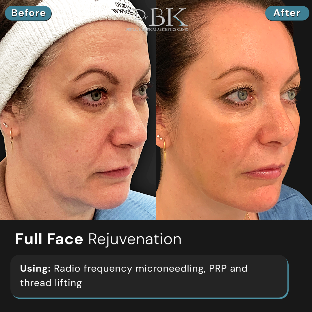 Radio Frequency Microneedling, PRP & Threads at DrBK