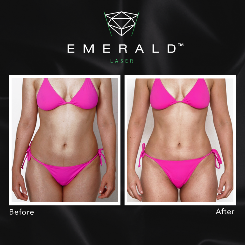 Emerald The Award Winning Fat Loss Laser Works Up To BMI