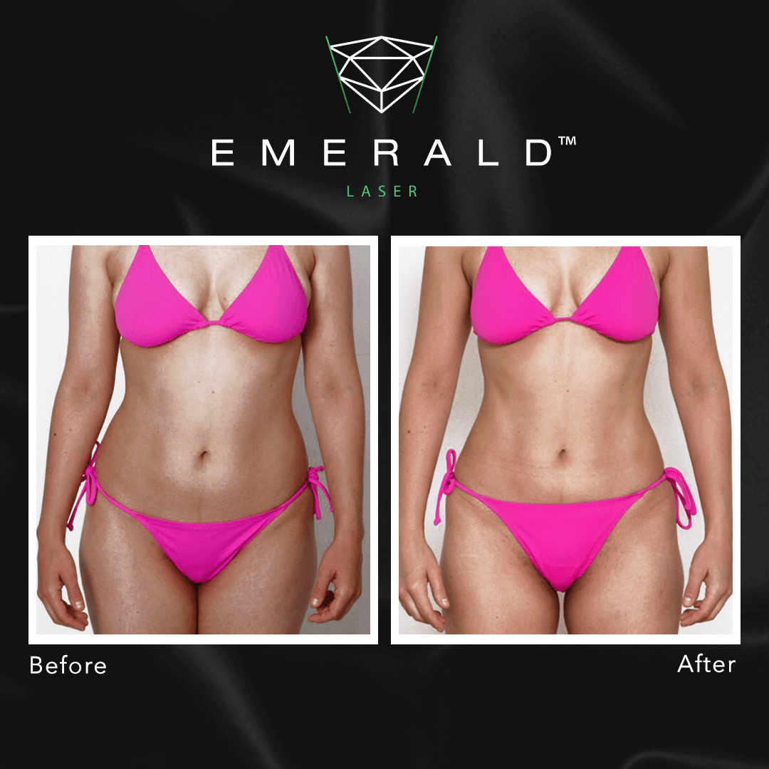 Emerald The Award Winning Fat Loss Laser Works Up To Bmi