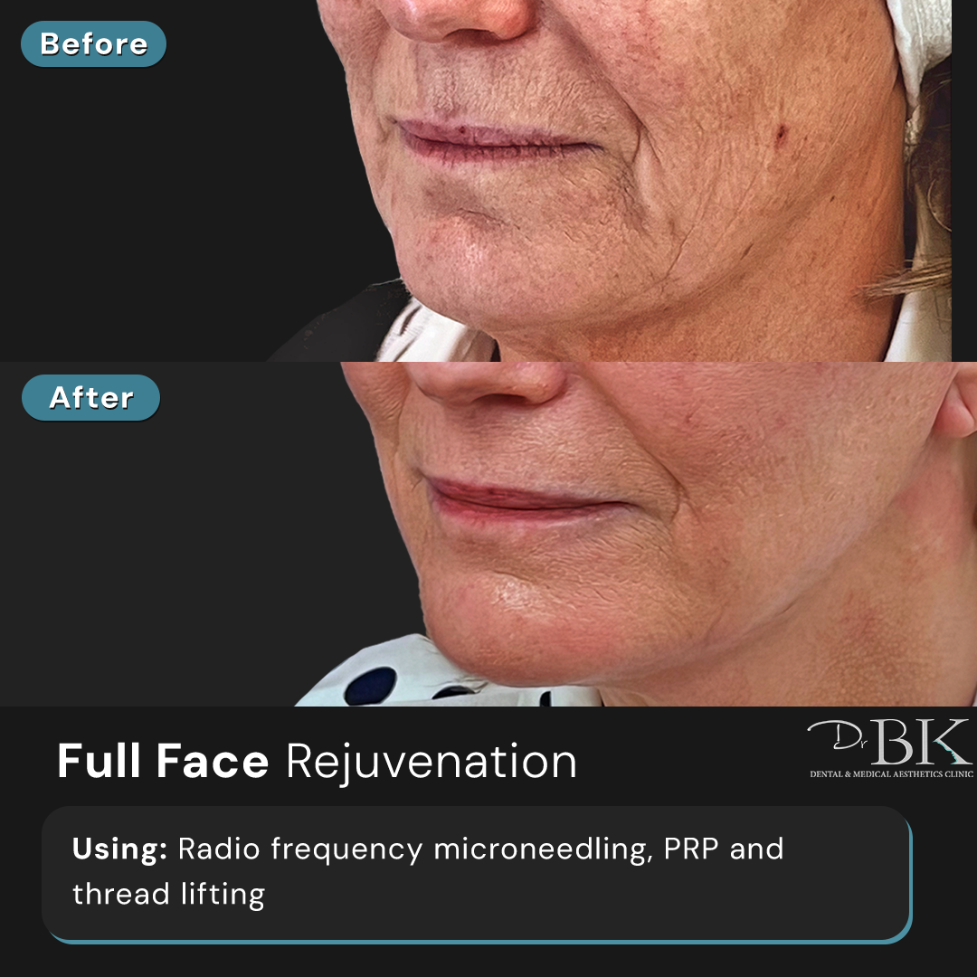 Radio Frequency Microneedling, PRP & Threads at DrBK