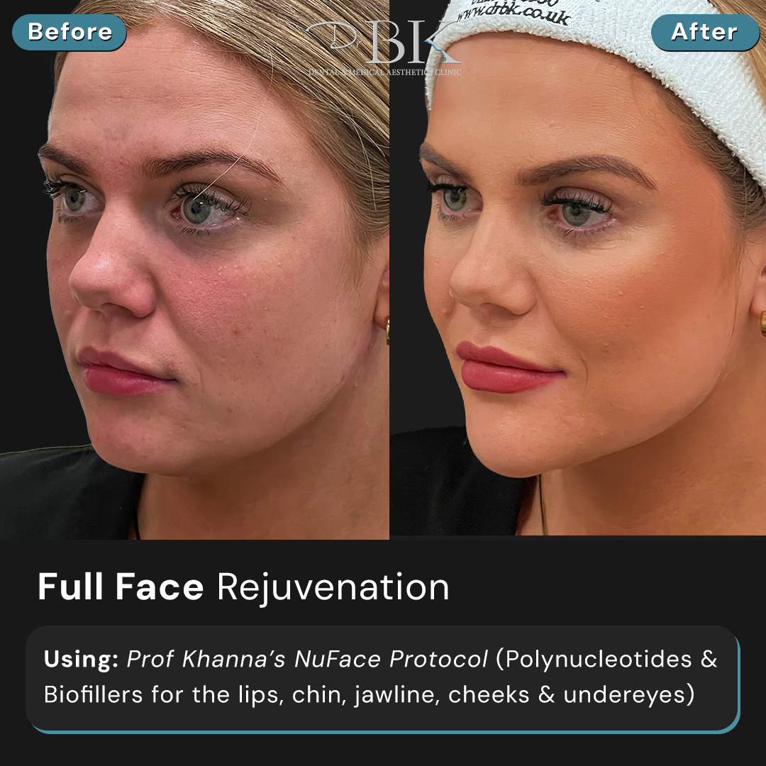 Full Face Transformation at DrBK (NuFace Protocol)