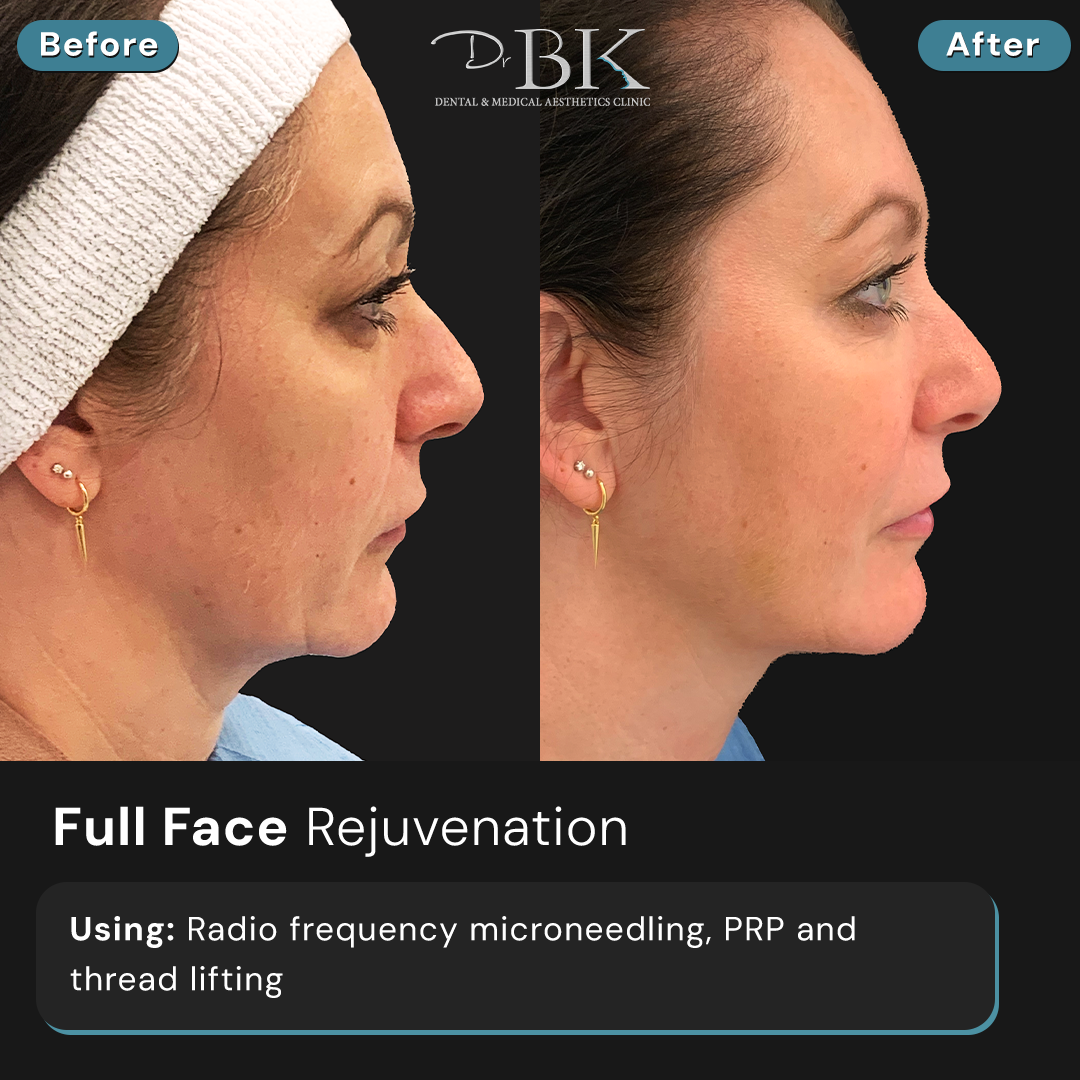 Radio Frequency Microneedling, PRP & Threads at DrBK