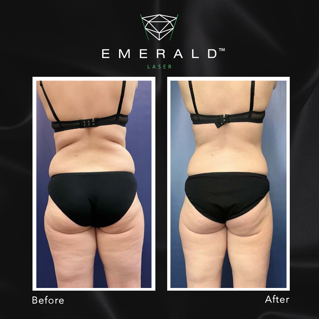 Emerald The Award Winning Fat Loss Laser Works Up To BMI