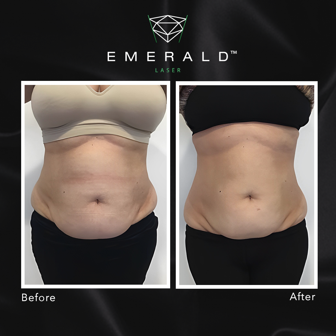 Emerald The Award Winning Fat Loss Laser Works Up To BMI