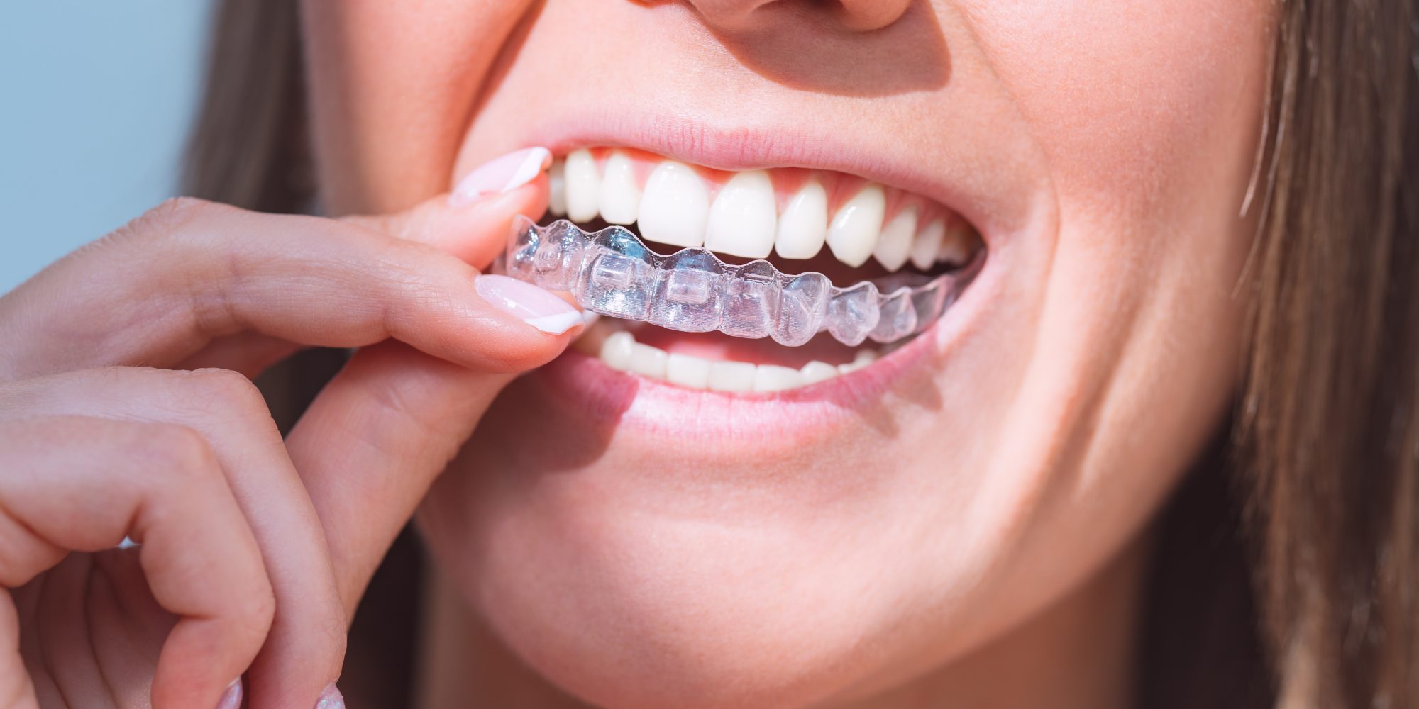 Clear aligners - smilelign - at DrBK Reading