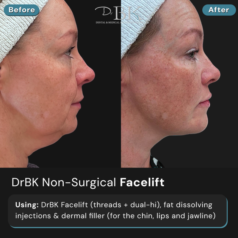 DrBK Facelift (thread lifting and dual-hi)