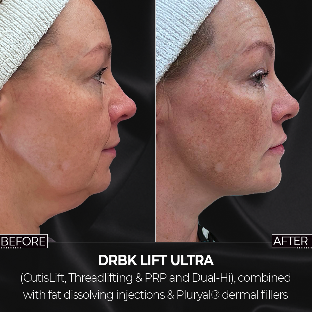 DrBK Lift - with Dual-Hi HIFU treatment