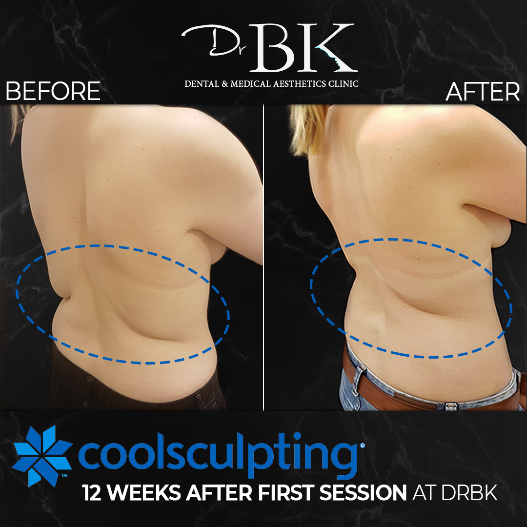 Coolsculpting Fat Freezing Treatment DrBK Clinic In Reading