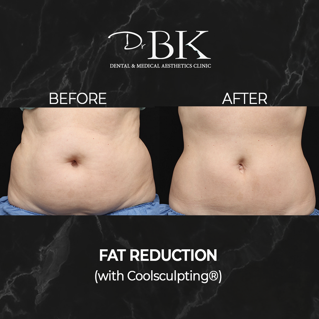 Coolsculpting Fat Freezing Treatment DrBK Clinic In Reading