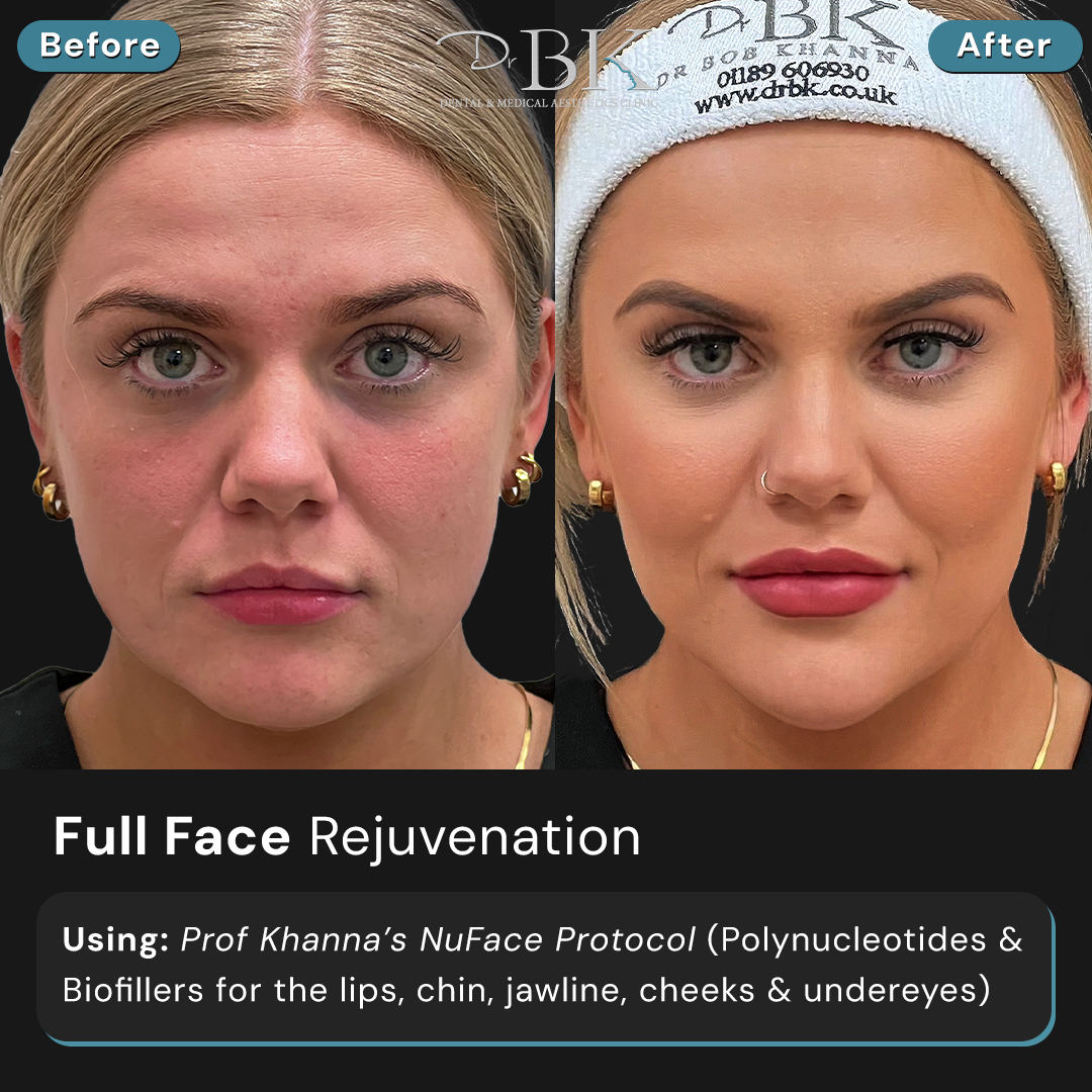 Full Face Transformation at DrBK (NuFace Protocol)