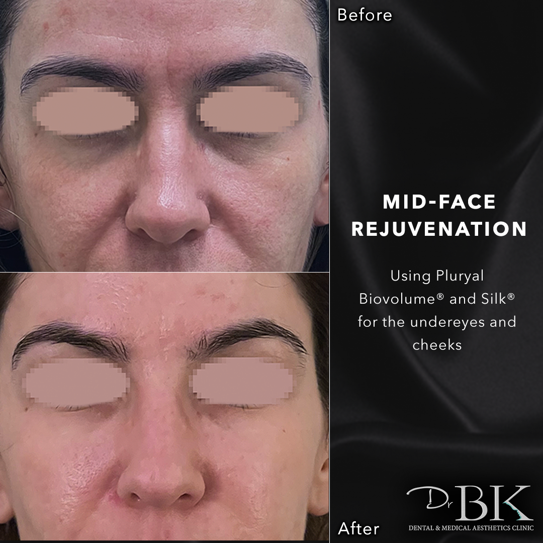 Tear trough rejuvenation using Polynucleotides - DrBK Clinic Reading & London