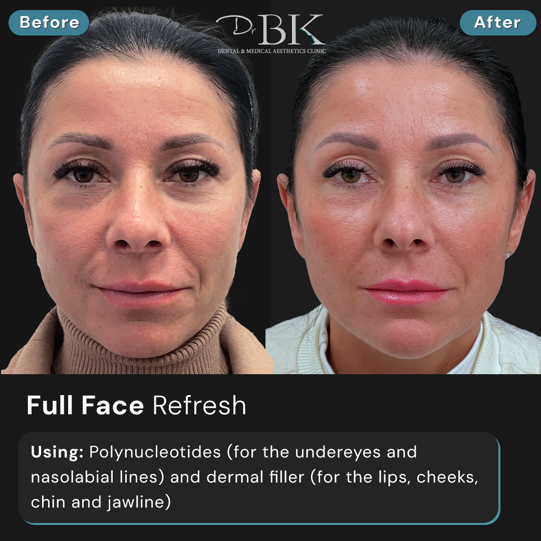 Full Face rejuvenation using Polynucleotides - DrBK Clinic Reading & London