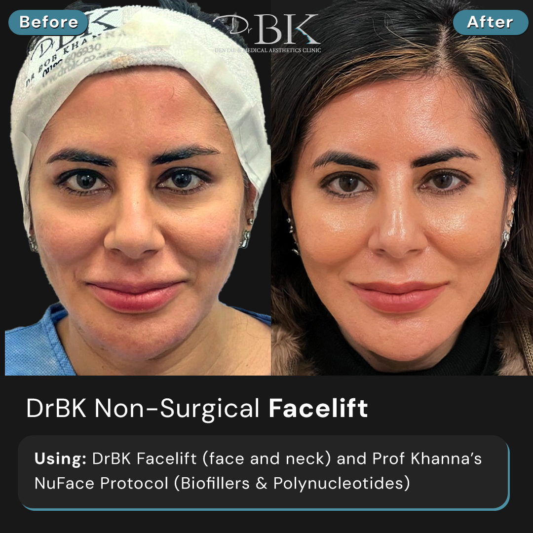 DrBK Facelift (Face & Neck)