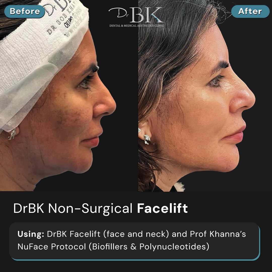 DrBK Facelift (Face & Neck)