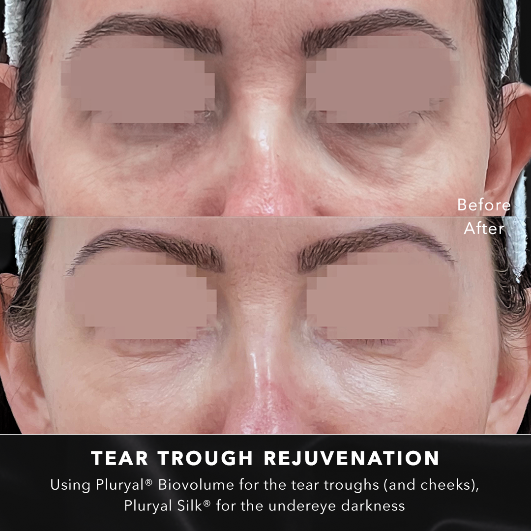 Tear trough rejuvenation using Polynucleotides - DrBK Clinic Reading & London