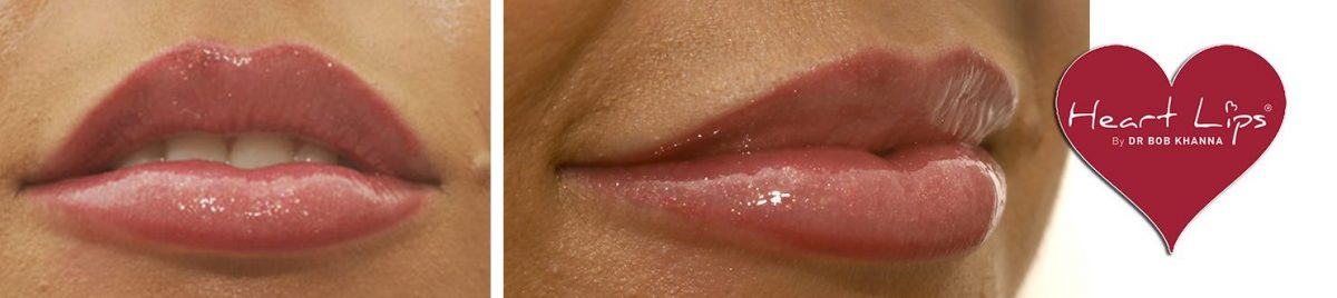 lip-fillers-heart-lips-drbk-cosmetic-dentist-aesthetics-clinic