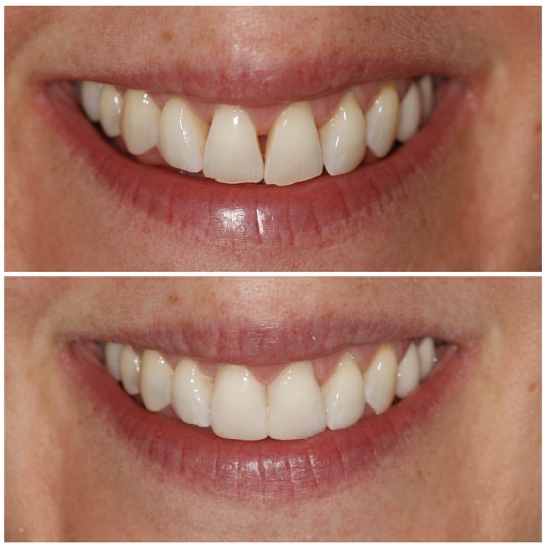 veneers dental cosmetic dentist composite before bonding drbk false last reading