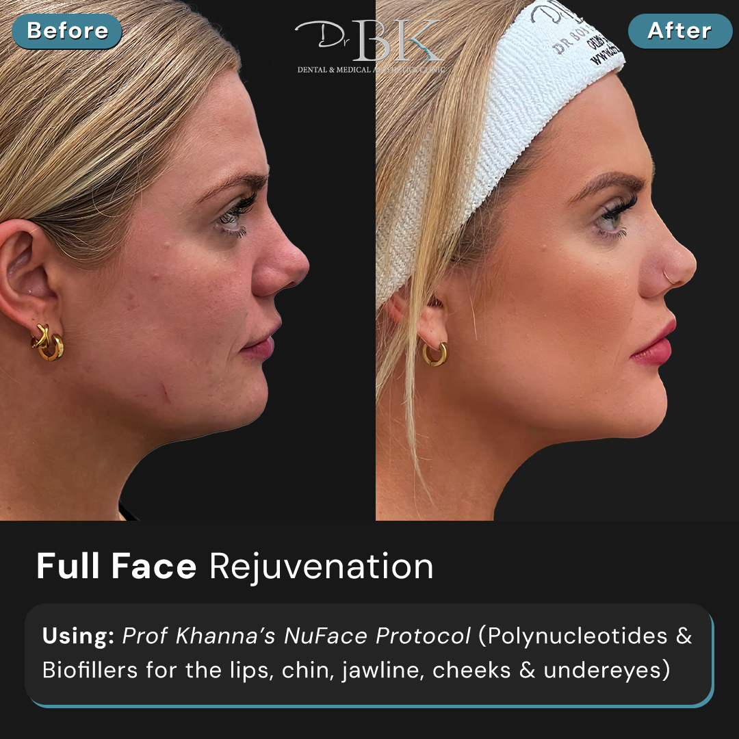 Full Face Transformation at DrBK (NuFace Protocol)