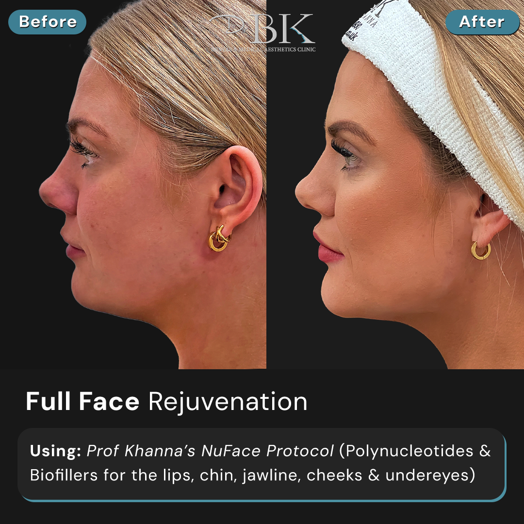 Full Face Transformation at DrBK (NuFace Protocol)