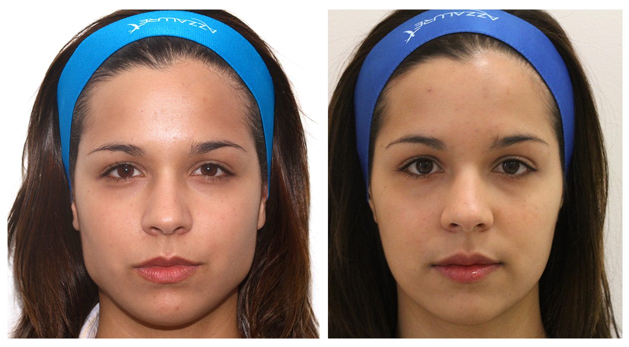 Facial Slimming - DrBK Cosmetic Dentist & Aesthetics Clinic in Reading