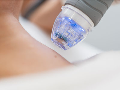 Radio Frequency Microneedling